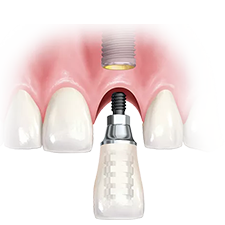 Digital Denta Implants