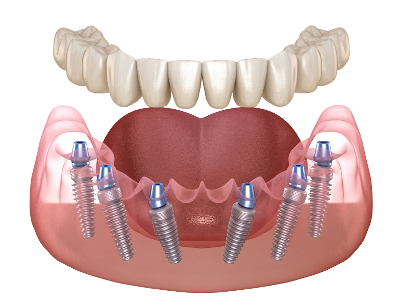 All on 6 dental implants Turkey