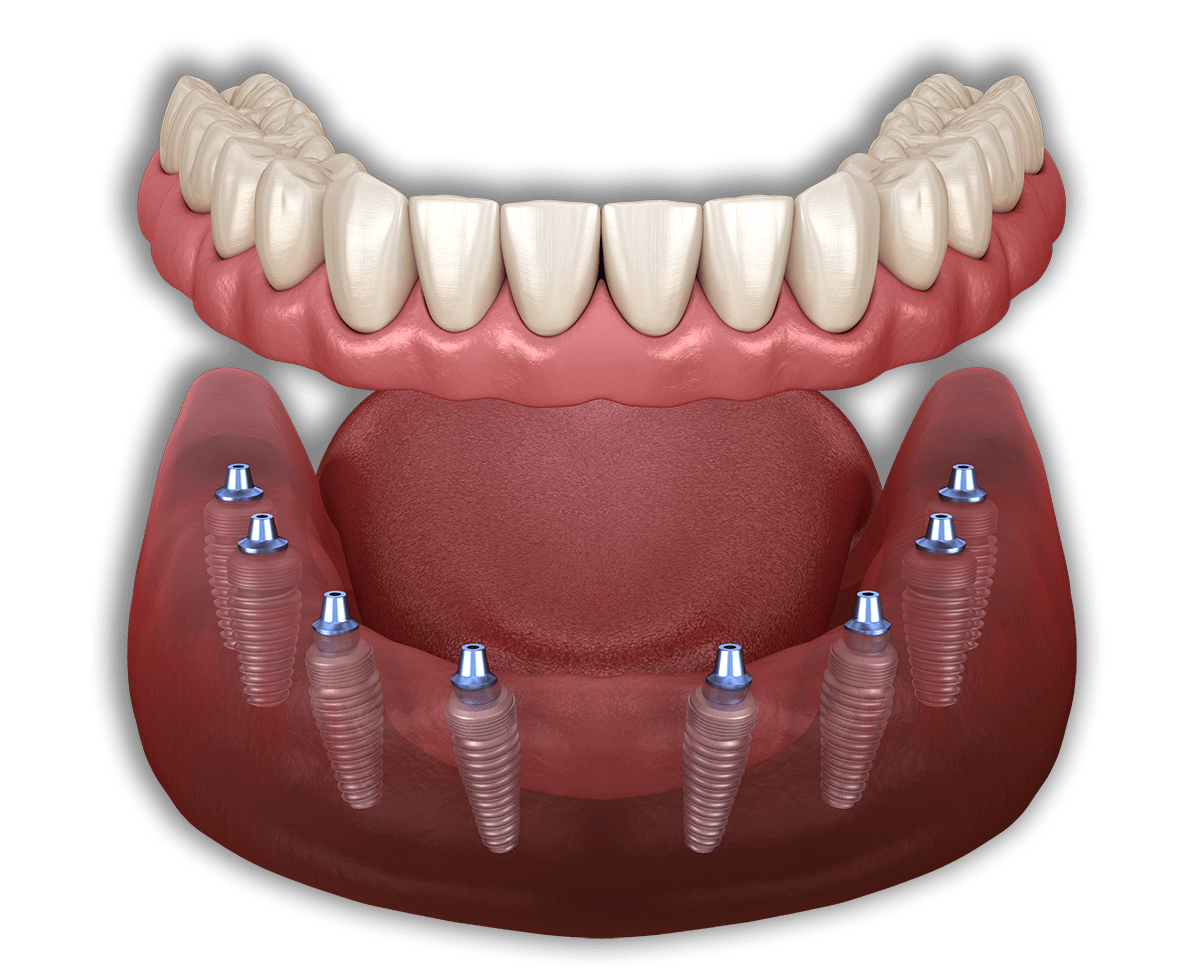 All on 8 Dental Implants in Turkey