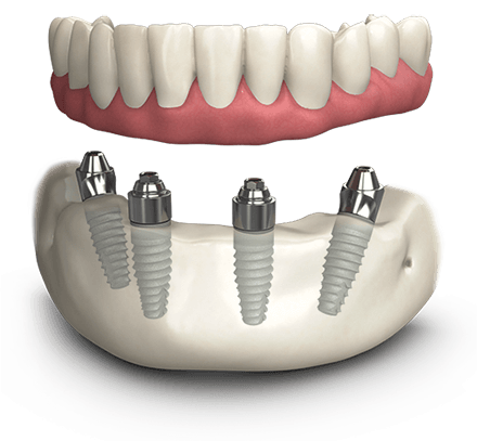 all on 4 dental implant turkey istanbul