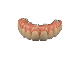 all on x Acrylic dental implant