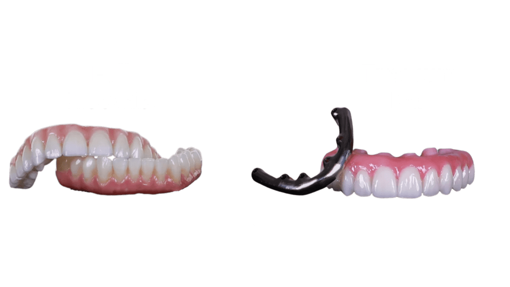 tybes of teeth over dental implant