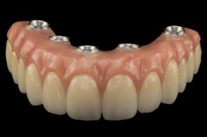 all on x Acrylic dental implant