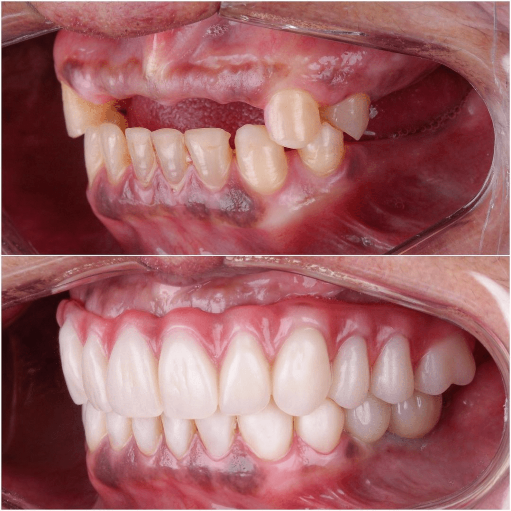 Dental Implants