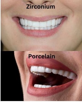 Dental Veneers in Turkey