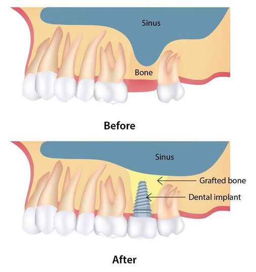 رفع الجيب الأنفي