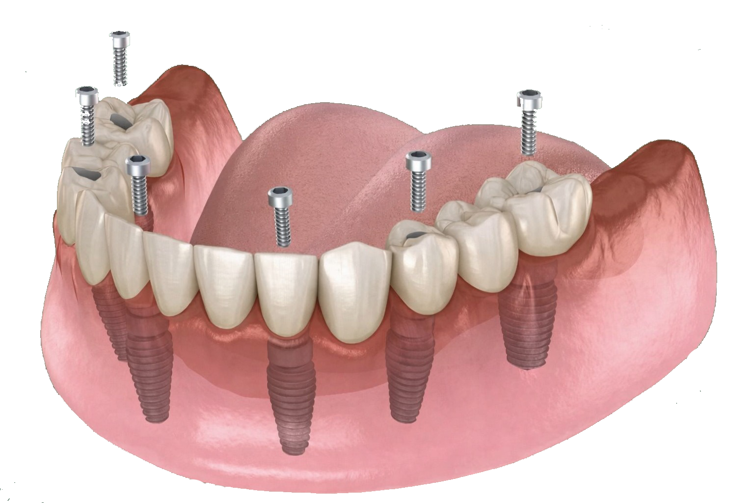 all-on-6 dental implants