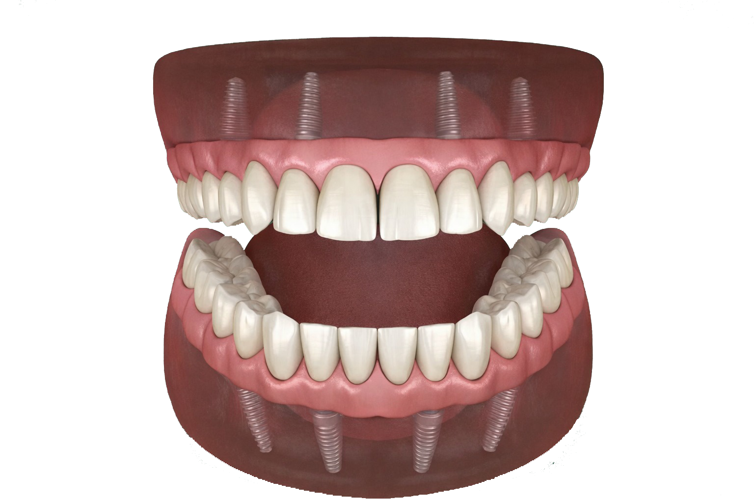 Full Mouth Dental Implants In Turkey