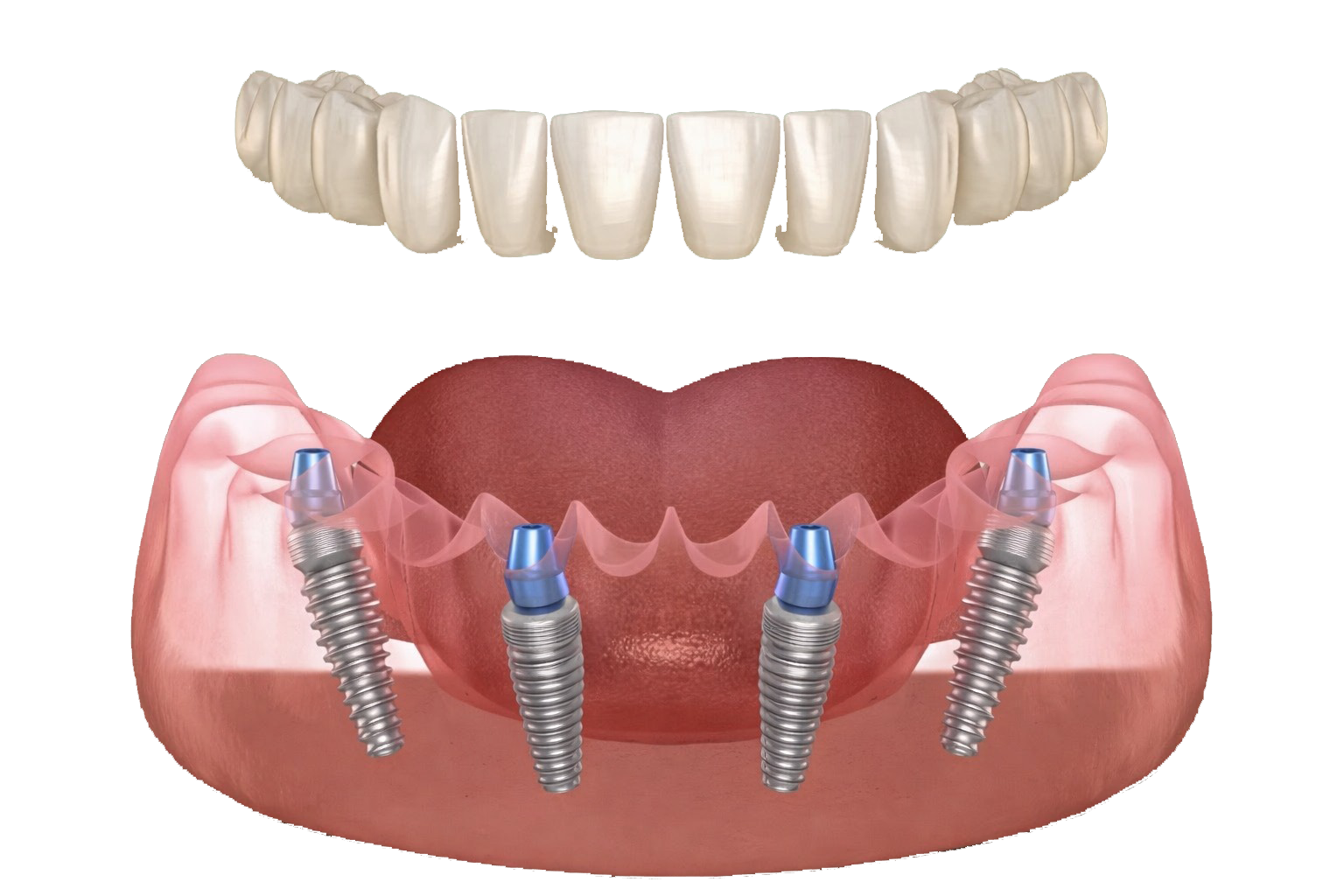all-on-4 dental implants