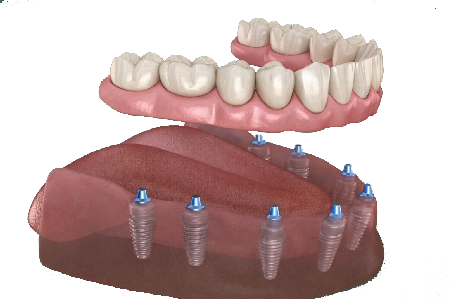 زراعة الاسنان في تركيا بتقنية all-on-8